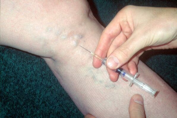 σκληροθεραπεία για κιρσούς