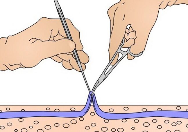 απογύμνωση φλεβών για κιρσούς