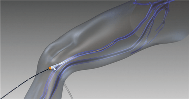 εξάλειψη ραδιοσυχνοτήτων για κιρσούς